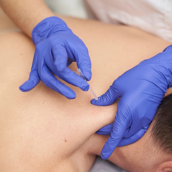 Medical professional performing acupuncture on a man's shoulder with blue gloves.