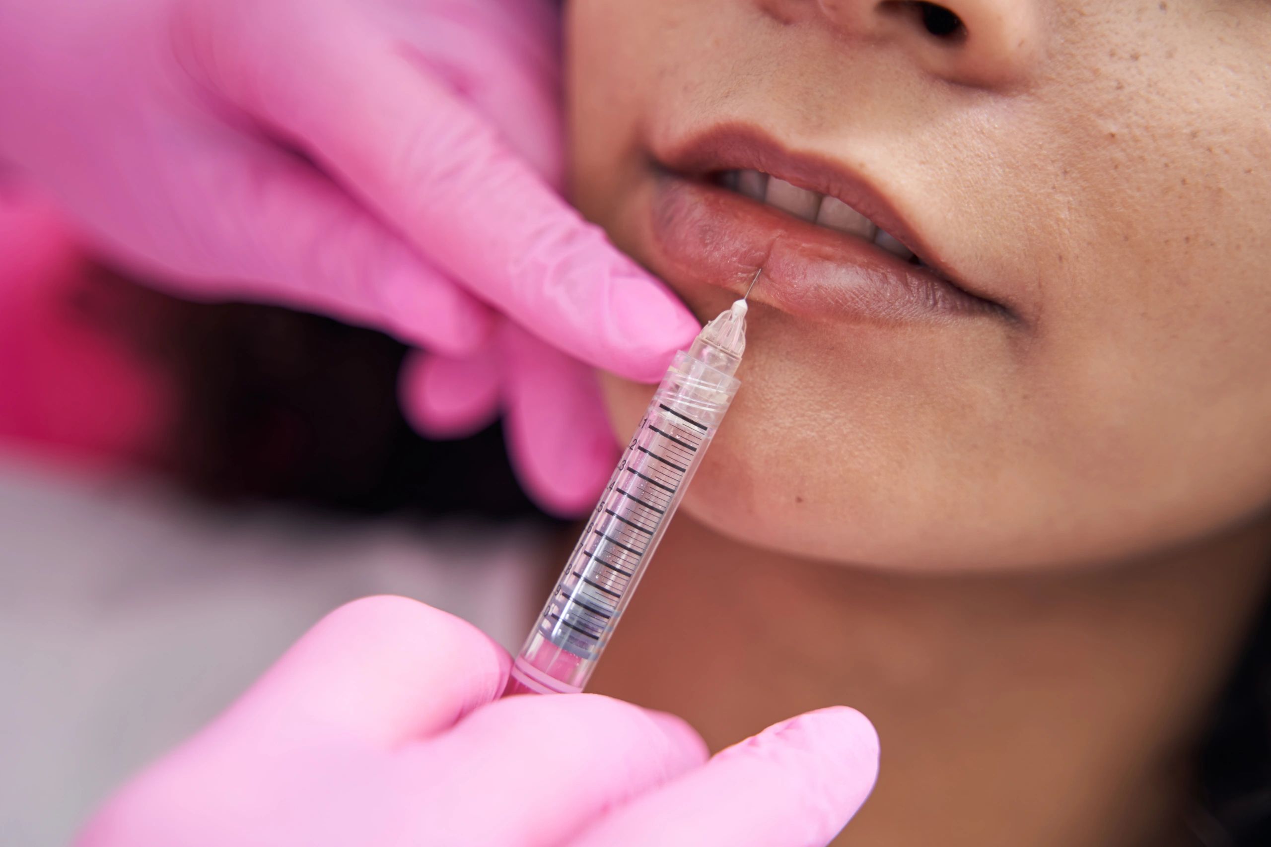 Lip Enhancement with Dermal Fillers in Woburn & Plaistow
