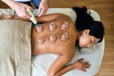 Woman receiving cupping therapy on her back