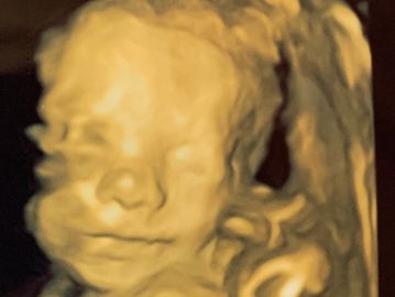 3D ultrasound image of a fetus.