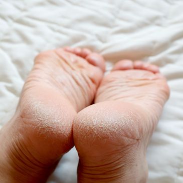 Hard Skin treatments