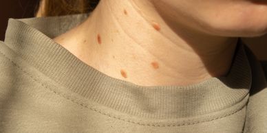 Treatment for brown pigmentation caused by sun damage