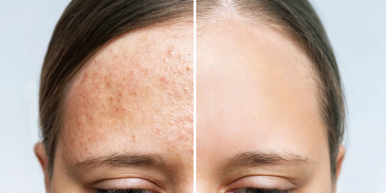 Acne scar removal Brisbane. Tired of acne? Our tailored  treatment plans focus on scar remodelling