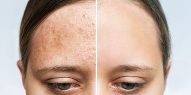 RACTIONAL RESURFACING SharpLight’s fractional resurfacing treatment is a gentle and efficient proced