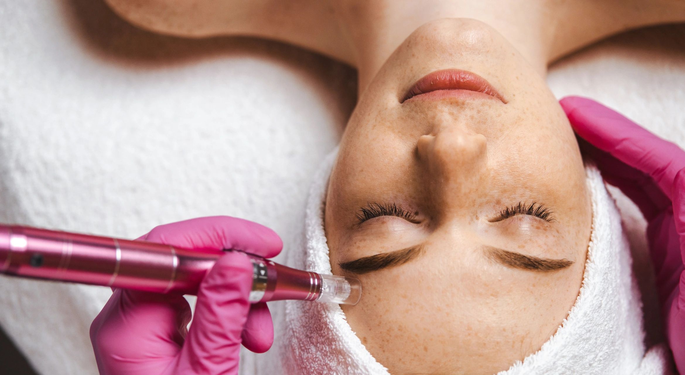Microneedling 