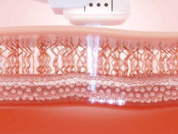 Tratamiento de Rejuvenecimiento facial con HIFU en Castelldefels