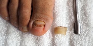 Close-up of a toenail with fungal infection and a removed thickened nail piece.
