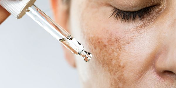 Close-up of facial serum being applied to skin with pigmentation spots.