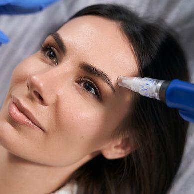 Woman receiving microneedling treatment on her forehead.