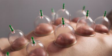 Cupping Therapy
