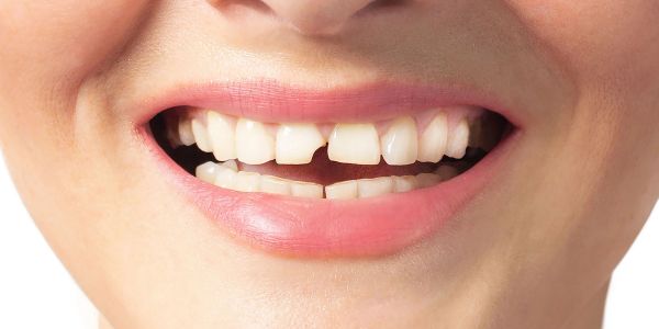Teeth smiling tooth on the left side of image in the front is broken 20% in the middle right corner