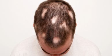 Man with patchy hair loss looking down, showing bald spots.