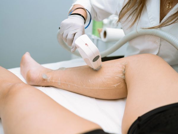 Eliminación de vello corporal con Láser Diodo en Castelldefels