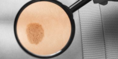 Birthmark