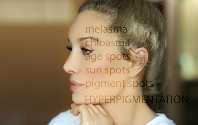 Dark spots, freckles,hyperpigmentation(melasma or chloasma),concept - skin lightening, skin whitening, fruit acids,AHA, Skin Brightening