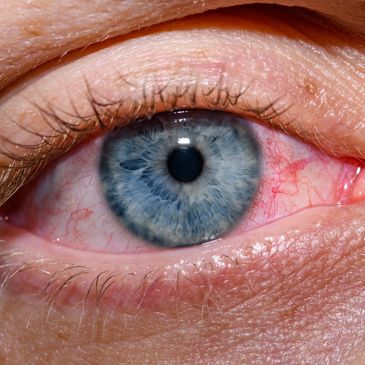 Close-up of a blue eye with visible blood vessels and detailed iris texture.