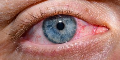 Close-up of a blue eye with visible blood vessels and detailed iris texture.