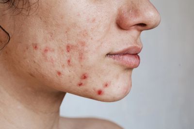 Causes of acne: excess oil production, clogged pores, hormonal changes, bacteria, inflammation. 