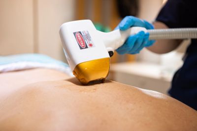 Laser hair removal treatment on a back.