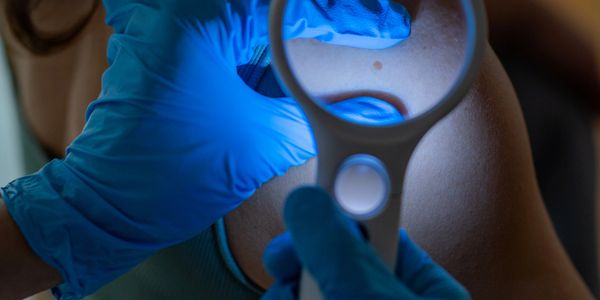 Dermatologist examining a mole on a patient's shoulder with a magnifying glass.