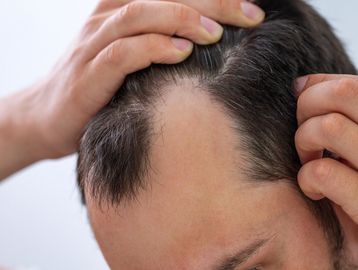 Close-up of a man showing hair loss at the front of his scalp.