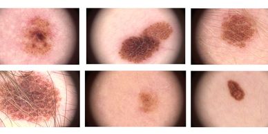 Close-up images of various skin moles with differing colors and textures.