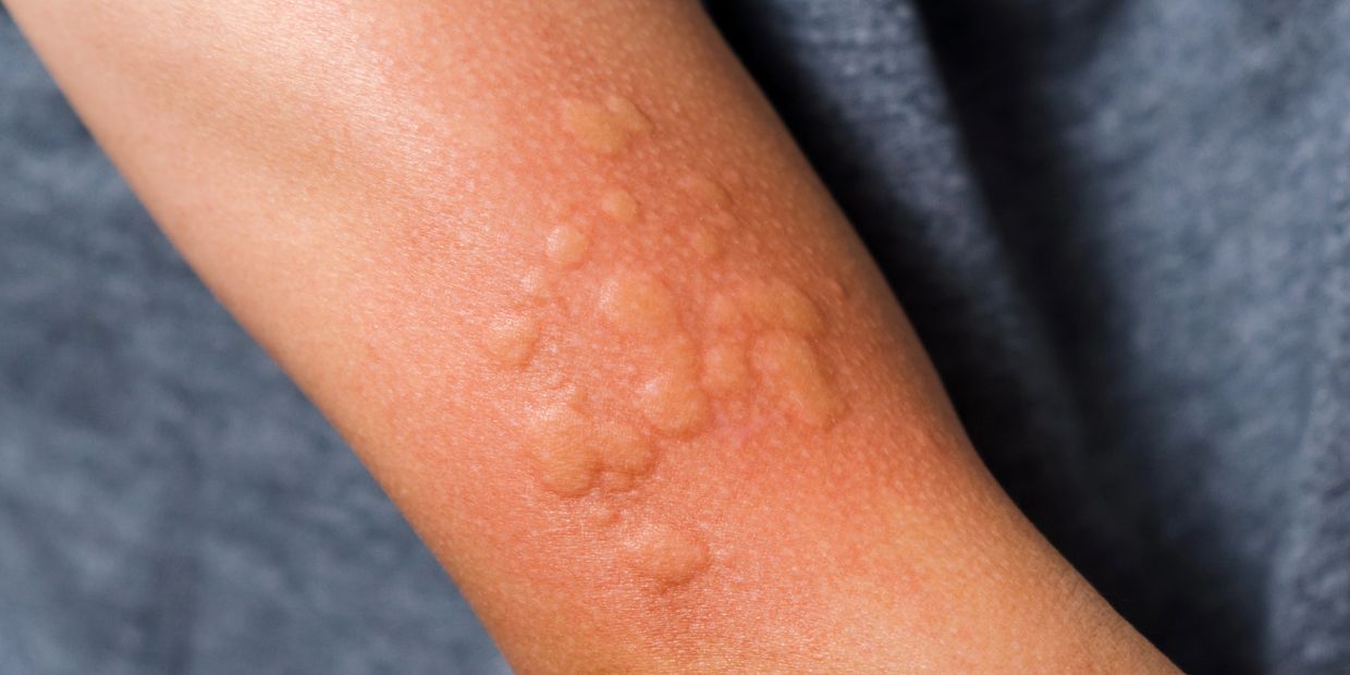 Close-up of skin with small raised bumps.