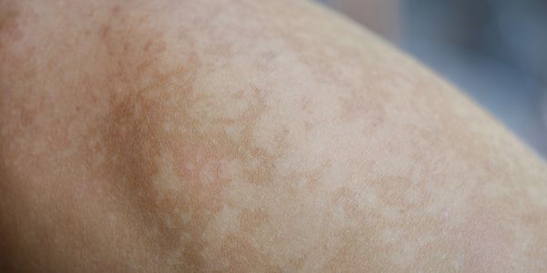 Pigmentation treatment