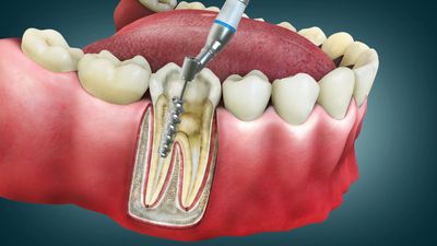 Dentist performing gentle root canal treatment at Save Dental in Orem, Utah to relieve tooth pain an