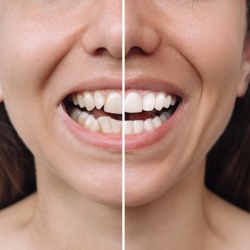 Smiling patient showing healthy teeth after dental crowns or fillings treatment.