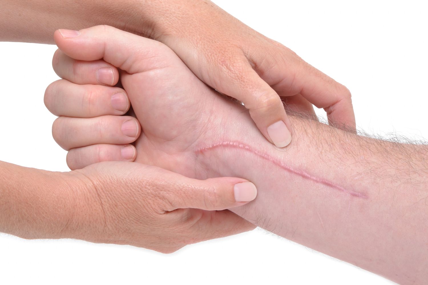 Hands examining a long scar on a forearm.