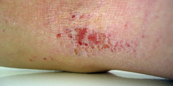 Egzama ciddi kaşıntıya yol açarak hayat kalitesini düşürebilir.