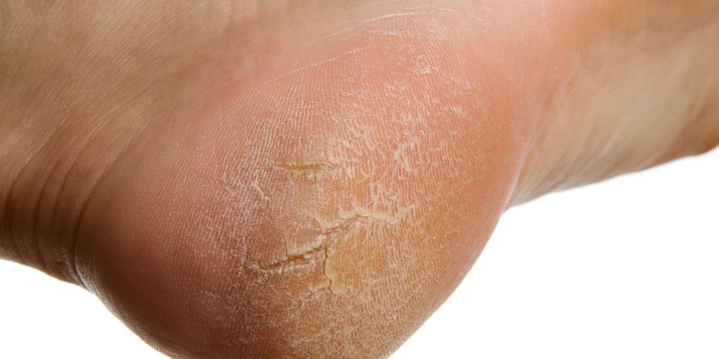 Peau desséchée et craquelée sur le talon.
