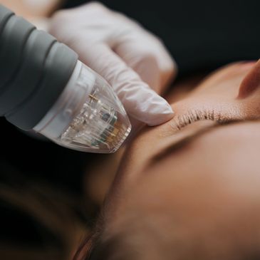 RF Microneedling combines microneedling with radiofrequency energy to stimulate collagen production
