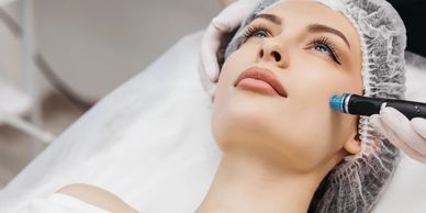 Microneedling with exosomes Columbus GA