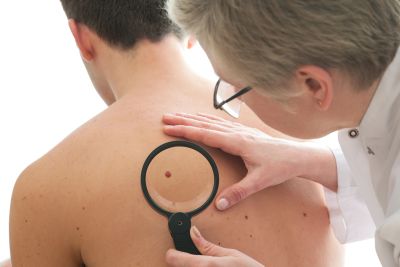Doctor examines a mole on a man's back with a magnifying glass.