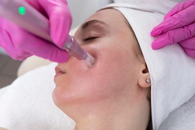 patient having microneedling in Owasso at pathway health and beauty to reduce acne and scars