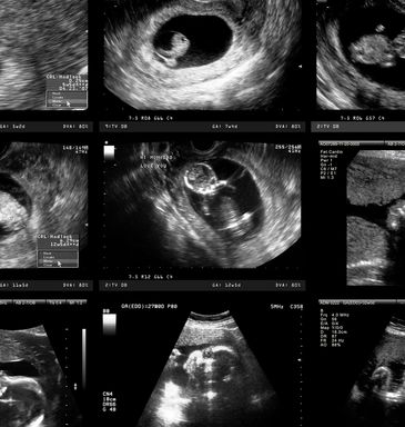 14-20 weeks ultrasound image