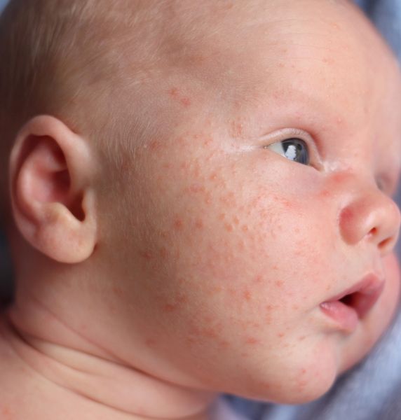 Close-up of a baby's face with mild red rash on the cheek.