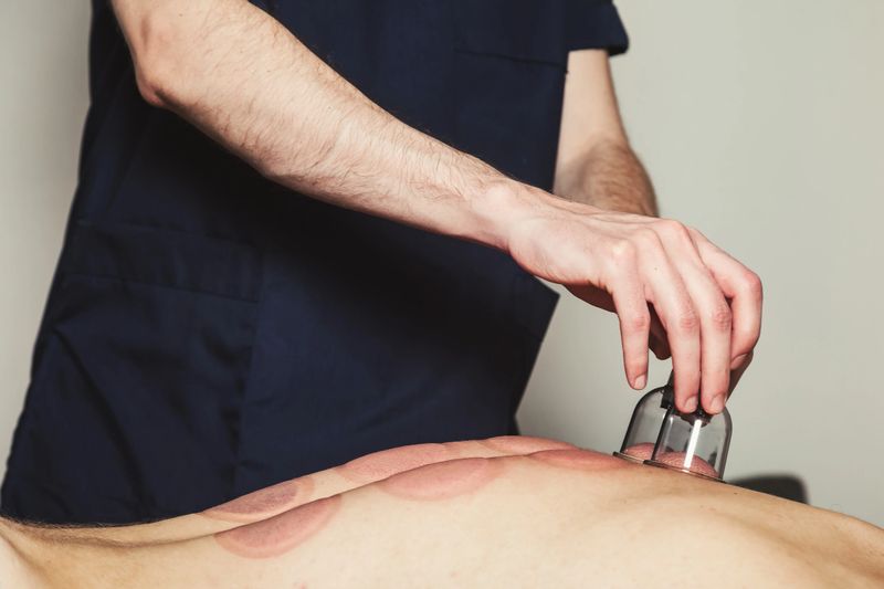 Doctor hands puts medical vacuum cups on patient back, close up. Medic vacuum cup, health rehabilitation, cupping therapy on human body. Wellness, alternative medicine concept. Copy ad text space