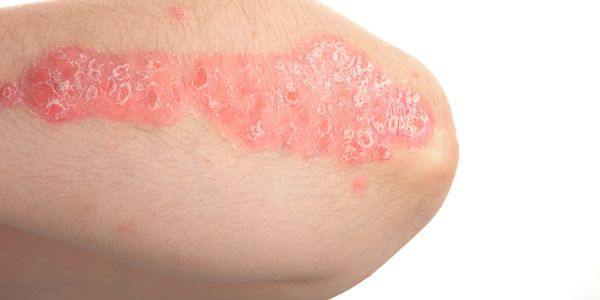 Dermatologist for Psoriasis treatment