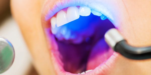 Close-up of a dental procedure with curing light.