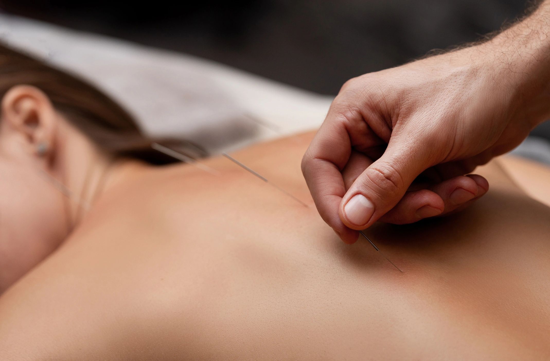Close-up of acupuncture needles being inserted into a person's back for therapy.