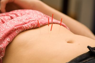 fertility acupuncture treatment 