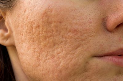 Acne scars: atrophic scars, raised scars.  Treatment regimen: chemical peels, laser, microneedling 