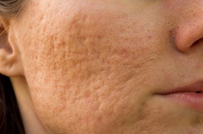Comprehensive Acne Treatment in Columbus Georgia. Improve active acne outbreaks and old acne scars.