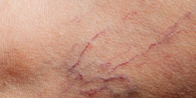 Thread vein