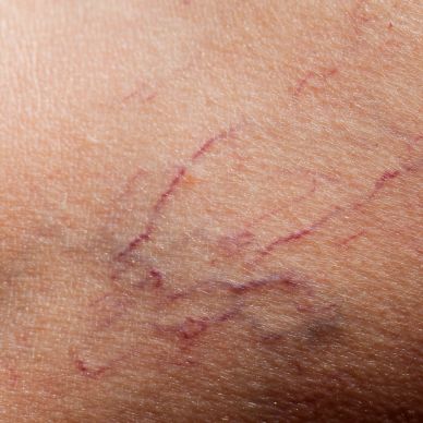 facial thread vein treatment chester