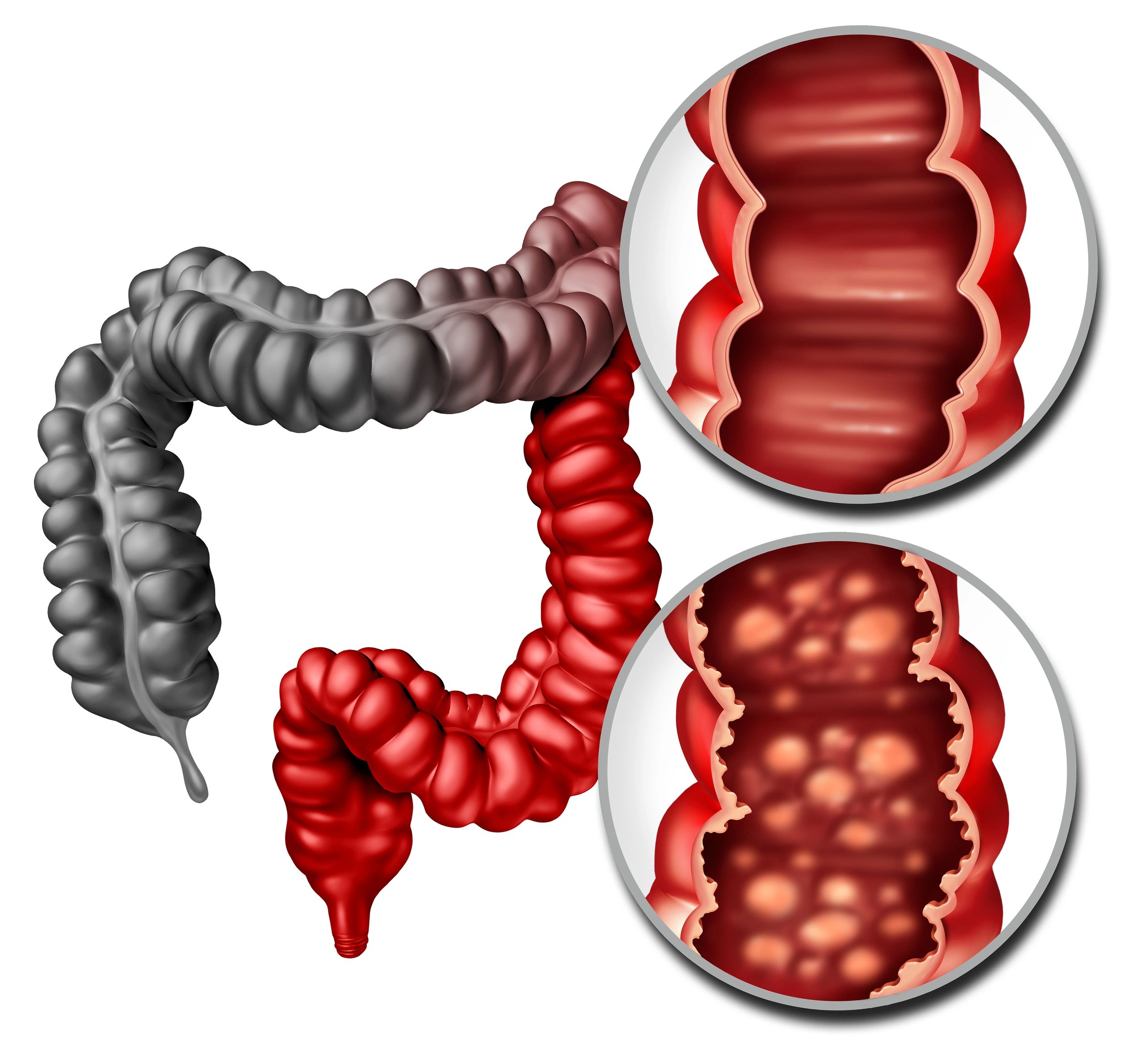 Ulcerative Colitis & Inflammation: A ROOT Cause Guide