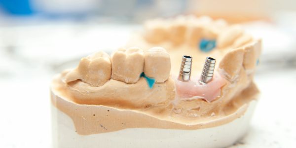 Dental model with two implants.